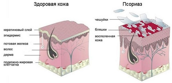 псориаз