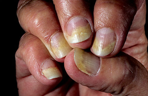 psoriaz-chto-ehto-za-bolezn