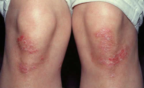psoriaz-chto-ehto-za-bolezn