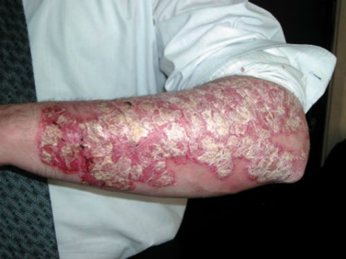 psoriaz-chto-ehto-za-bolezn