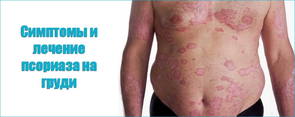 Симптомы и лечение псориаза на груди