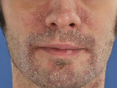 psoriaz kasalligi