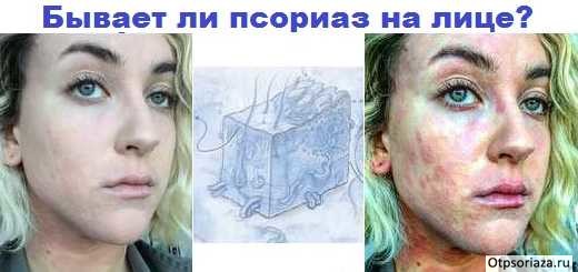 Псориаз на лице причины