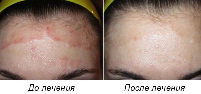 псориаз на голове до и после