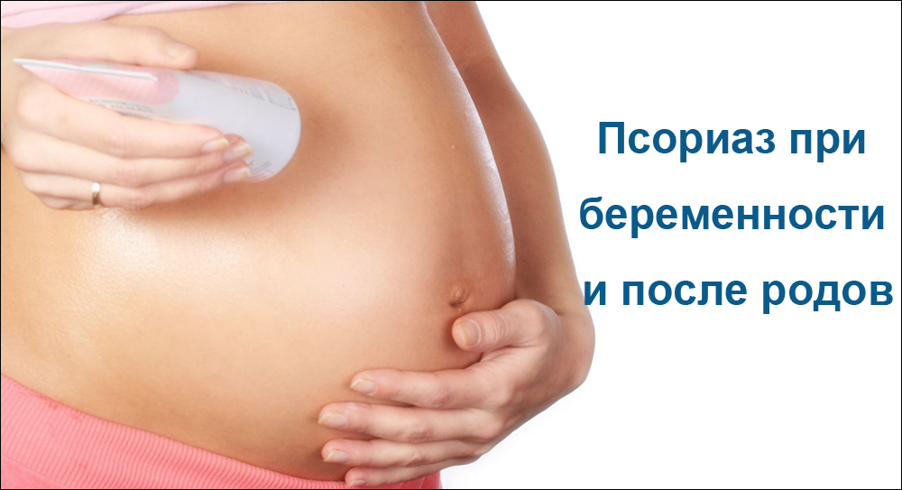 Псориаз при беременности и после родов