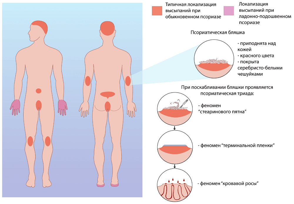 псориаз рисунок-1