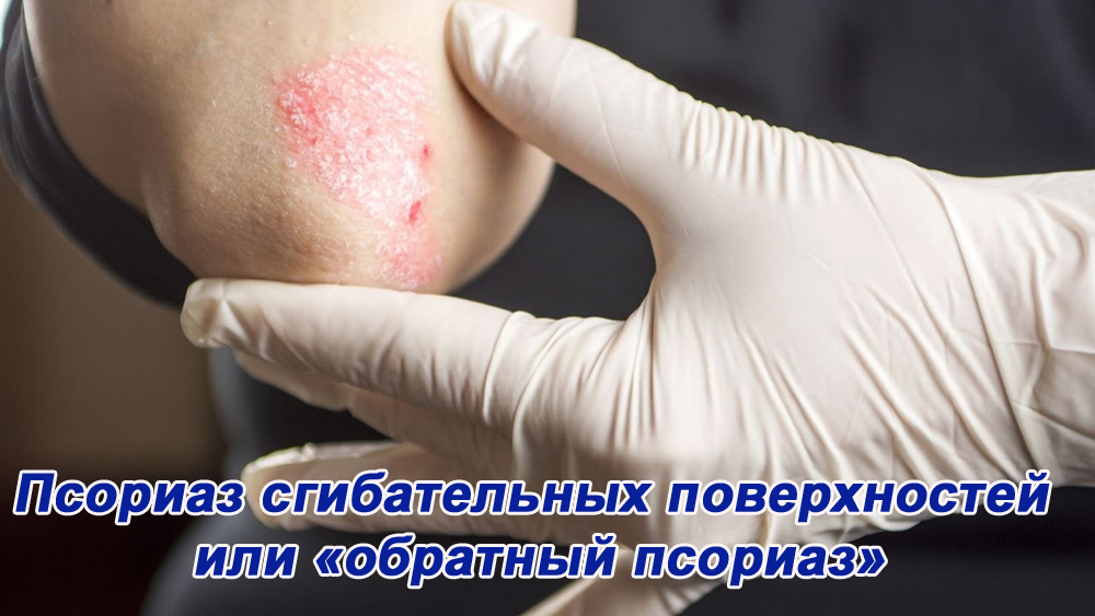 Псориаз сгибательных поверхностей или «обратный псориаз»