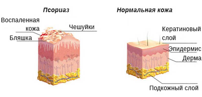 Бляшечный псориаз – симптомы, формы, особенности лечения и эффективные средства