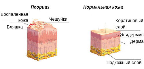 псориаз схема