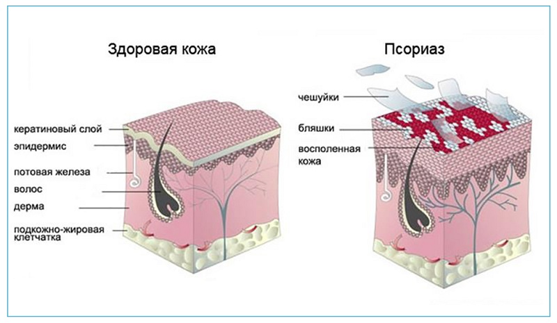 псориаз на голове