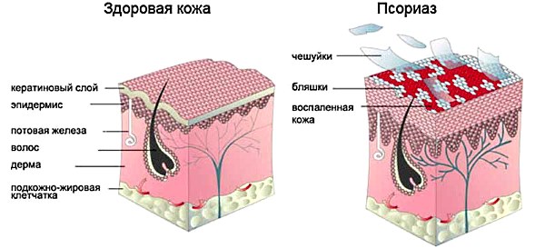 Псориаз. Симптомы, причины появления и развития болезни, формы и стадии