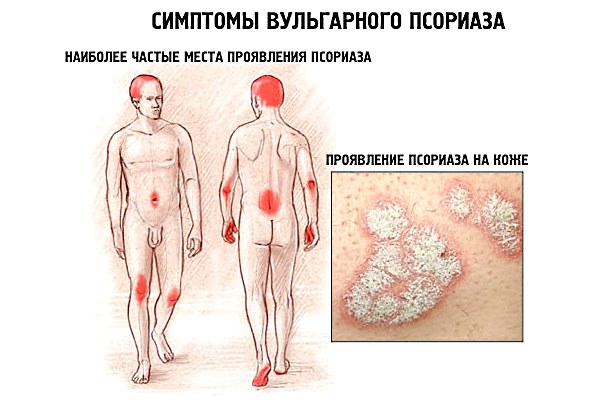 Псориаз. Симптомы, причины появления и развития болезни, формы и стадии