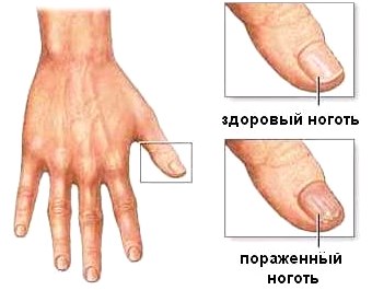 Псориаз ногтей