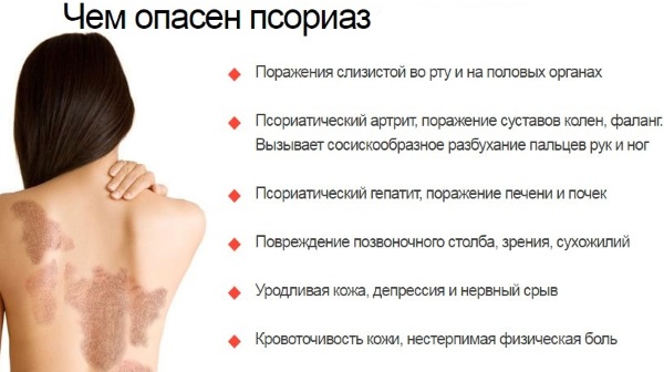 Псориаз у детей. Фото, стадии, причины и лечение, рекомендации врачей