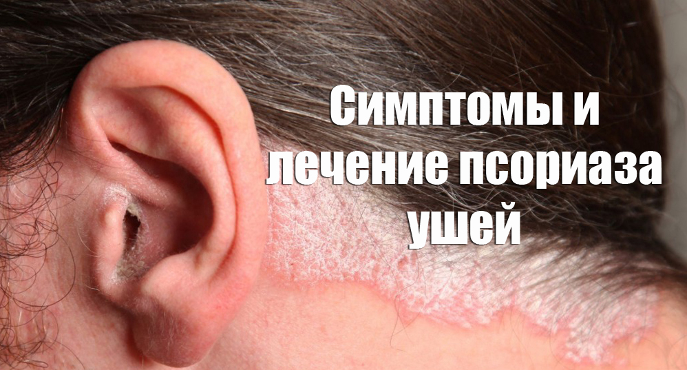 Псориаз в ушах