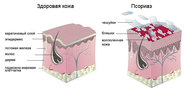 psoriaz-zdorov