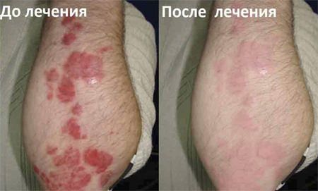 лечение псориаза