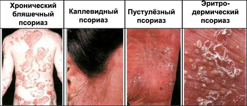 каплевидный псориаз причины возникновения и лечение
