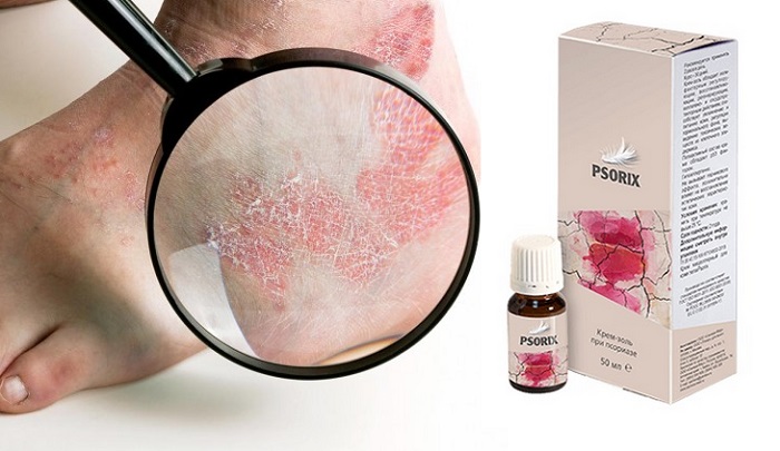 Psorix от псориаза: действует там, где другие препараты бессильны!
