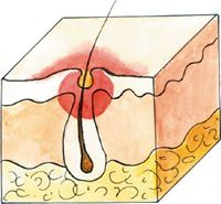 pustula - Основной морфологический элемент сыпи при экземе