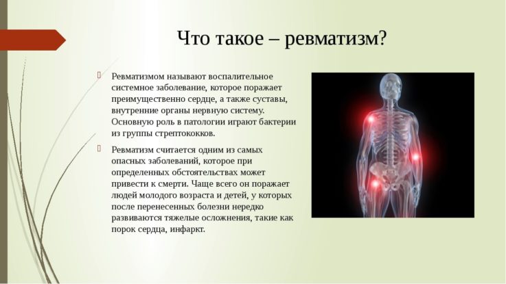 Что такое ревматизм