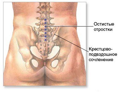Сакроилеит тазобедренного сустава