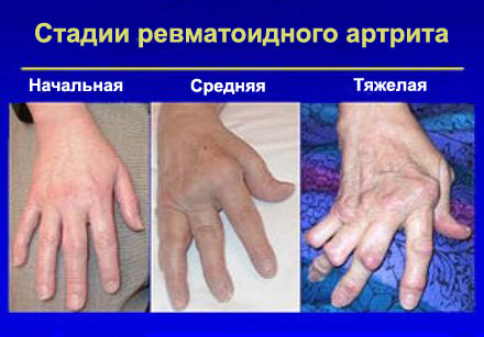 Распухли суставы на пальцах рук как лечить