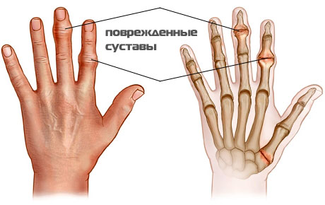 Распухли суставы на пальцах рук как лечить