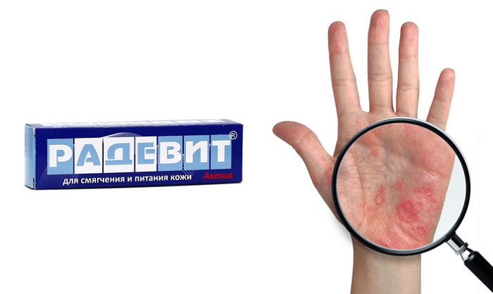 Радевит® Актив от псориаза: лучший способ восстановить здоровье кожи!