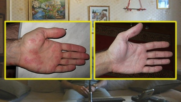 результат лечения