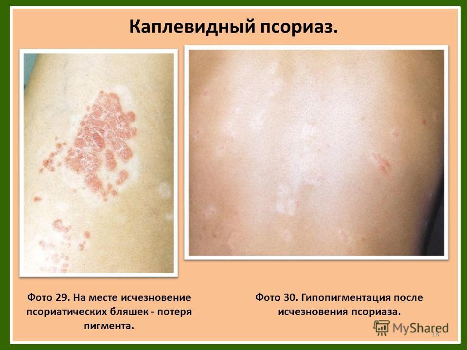 Процесс гипопигментации после исчезновения псориаза