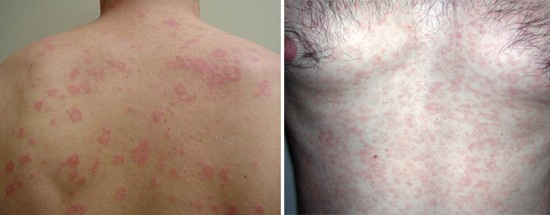 Скрытый сифилис ранний и поздний: симптомы, признаки, диагностика ...