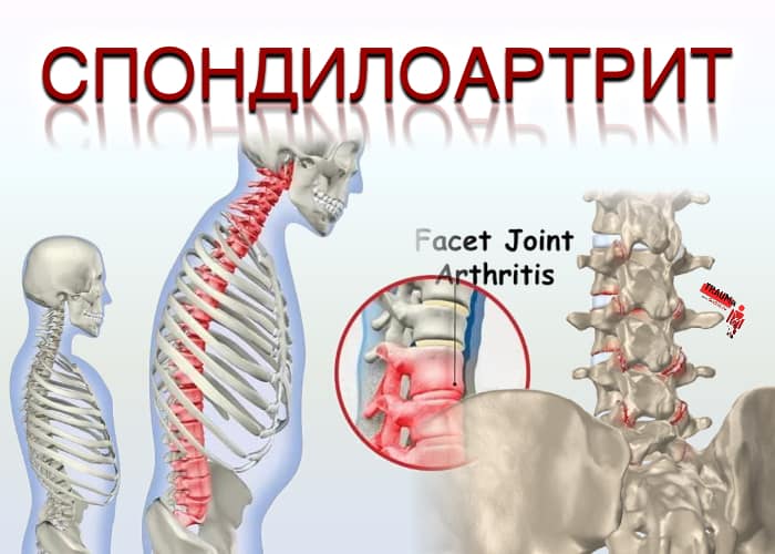 Периферический спондилоартрит что это такое