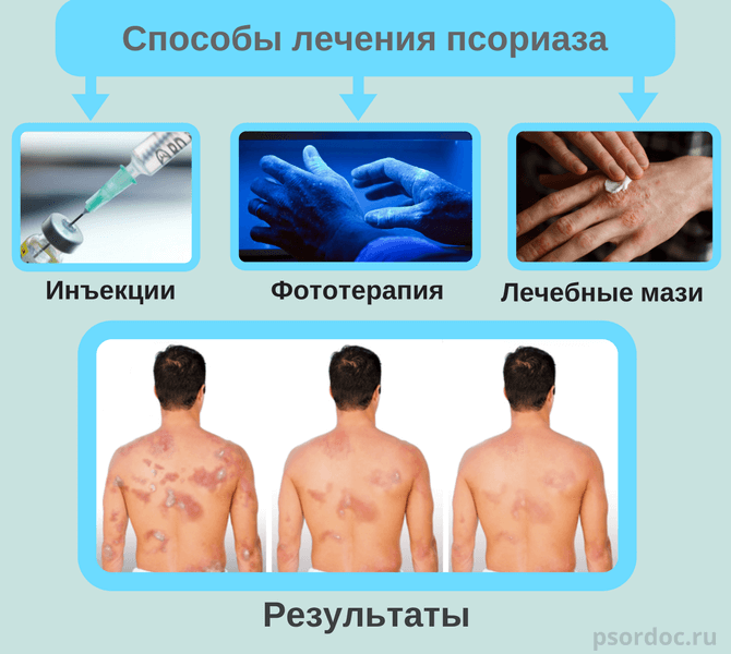 способы лечения псориаза
