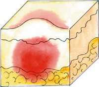 tuberculum - Основной морфологический элемент сыпи при экземе