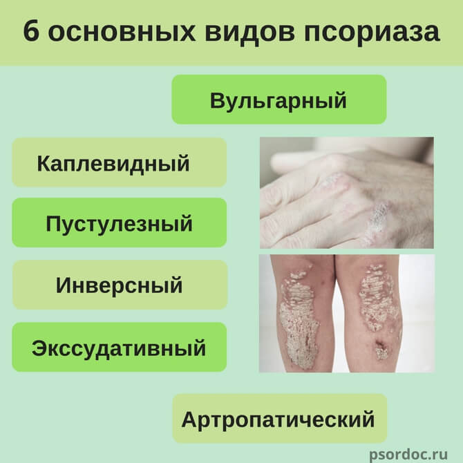 виды псориаза