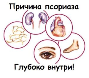 причины псориаза