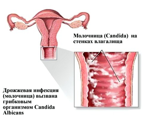 Молочница у женщин