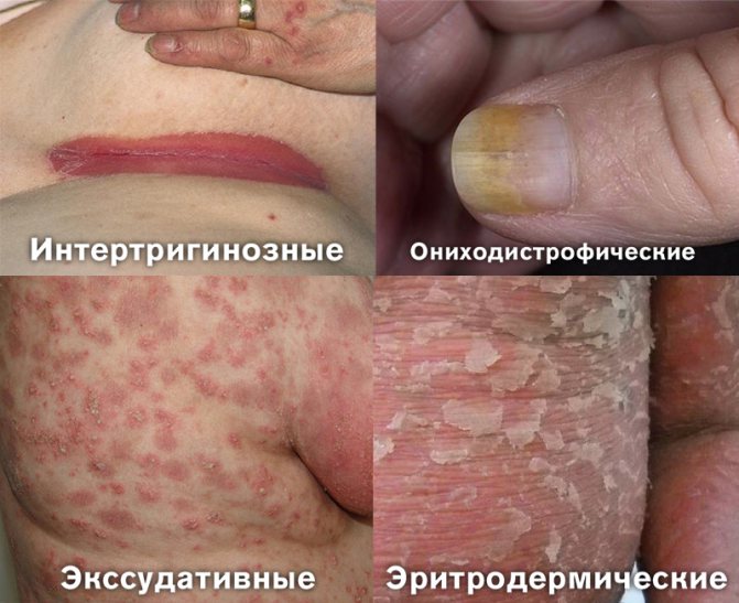 Обострение псориаза — что делать самостоятельно дома?