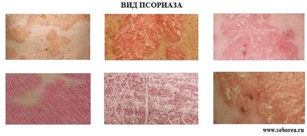 виды псориаза