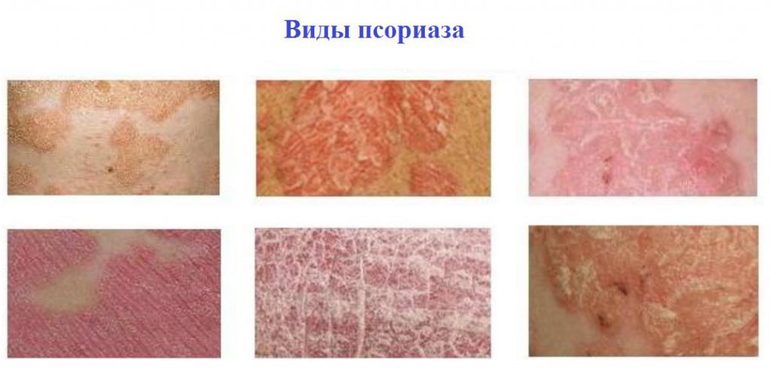 Виды псориаза