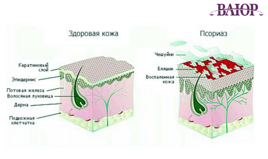 Призывнику, страдающему этим дерматологическим заболеванием, призывная комиссия может дать заключение о непригодности к строевой службе в армии.