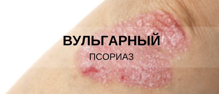 Бляшечный псориаз лечение