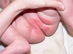 Опрелость на попе у ребенка