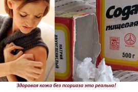 Как лечить псориаз пищевой содой — эффективные методы
