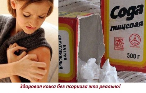 Как лечить псориаз пищевой содой — эффективные методы