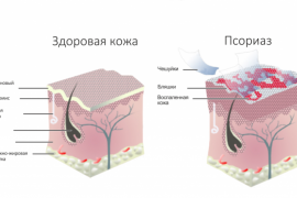 псориаз 2015