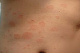 Болезнь псориаз: симптомы, лечение, диета