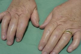 Лечение подагрического артрита