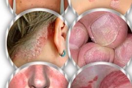 Псориатический полиартрит симптомы и лечение